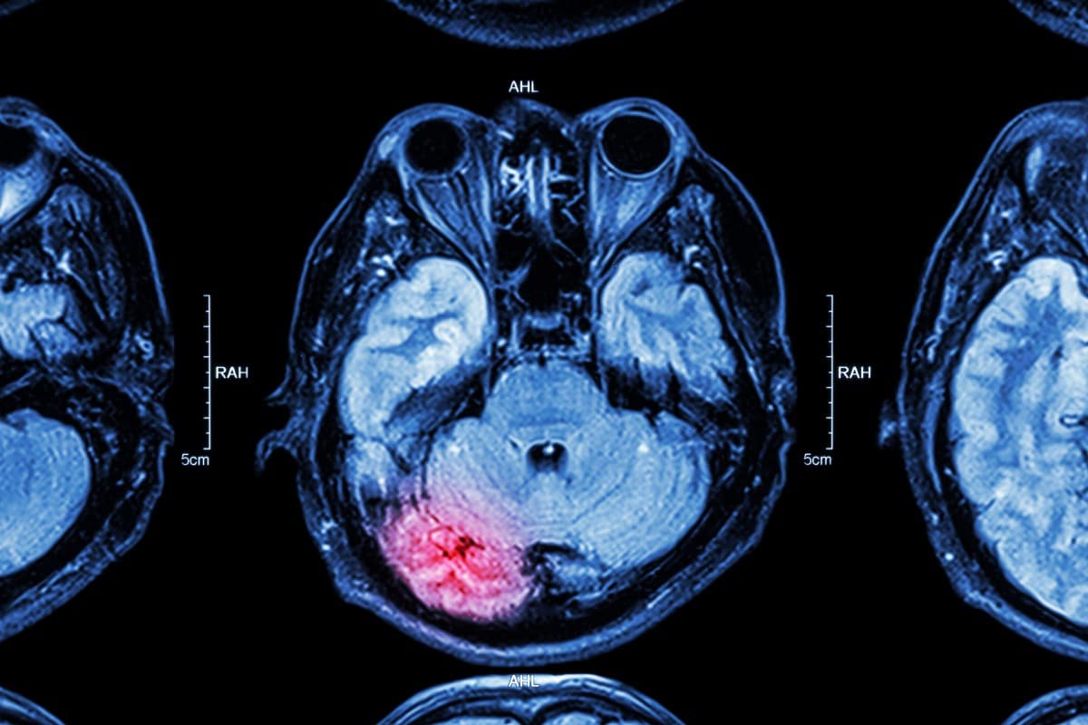 Cognitive Rehabilitation Therapy For A Traumatic Brain Injury (TBI)